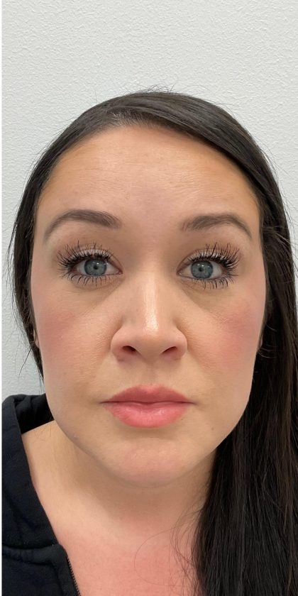 Botox Before & After Patient #4166