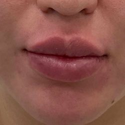 Lip Fillers Before & After Patient #4180