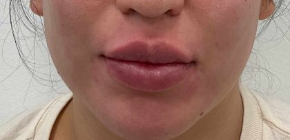 Lip Fillers Before & After Patient #4180