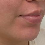 Lip Fillers Before & After Patient #4180