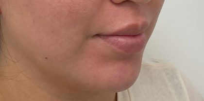 Lip Fillers Before & After Patient #4180