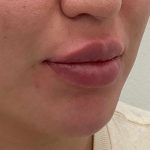 Lip Fillers Before & After Patient #4180