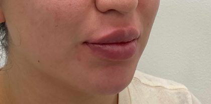 Lip Fillers Before & After Patient #4180
