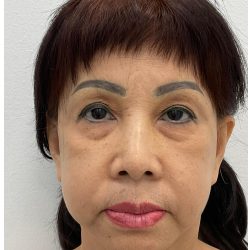 Lower Blepharoplasty Before & After Patient #4184