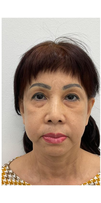 Lower Blepharoplasty Before & After Patient #4184