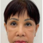 Lower Blepharoplasty Before & After Patient #4184