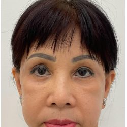 Lower Blepharoplasty Before & After Patient #4184