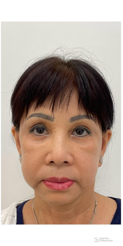 Lower Blepharoplasty Before & After Patient #4184