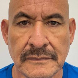 Upper Blepharoplasty Before & After Patient #4183