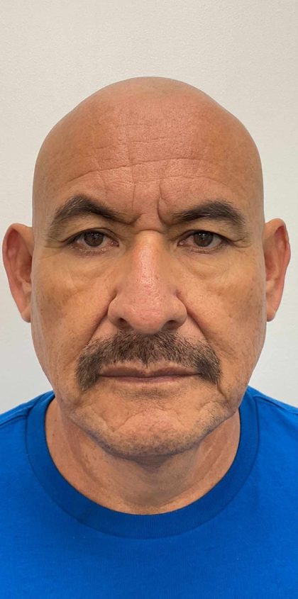 Upper Blepharoplasty Before & After Patient #4183