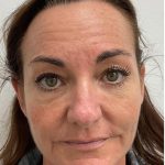 Botox Before & After Patient #4173