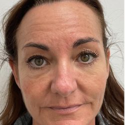 Botox Before & After Patient #4173
