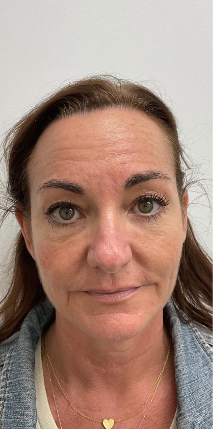Botox Before & After Patient #4173