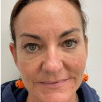Botox Before & After Patient #4173