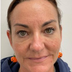 Botox Before & After Patient #4173