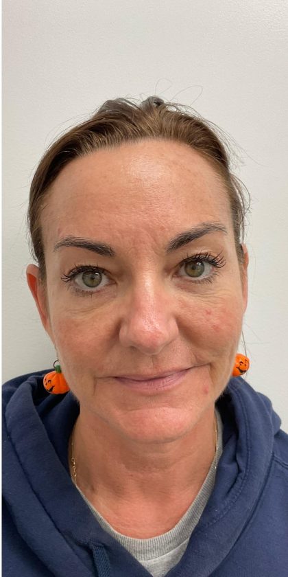 Botox Before & After Patient #4173