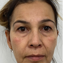 Under Eye Fillers Before & After Patient #4185