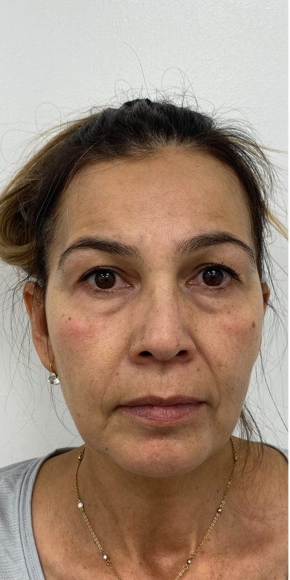 Under Eye Fillers Before & After Patient #4185
