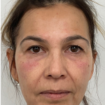 Under Eye Fillers Before & After Patient #4185