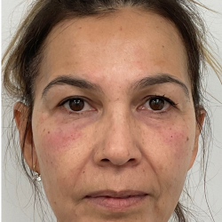 Under Eye Fillers Before & After Patient #4185