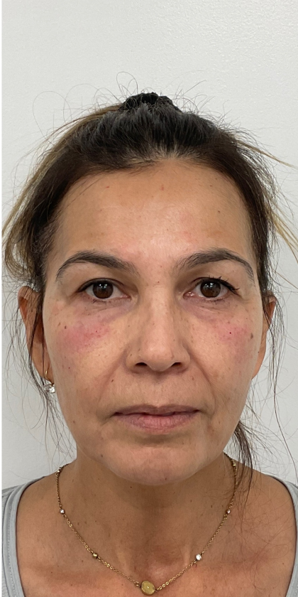 Under Eye Fillers Before & After Patient #4185