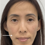 Facial Fillers Before & After Patient #4130