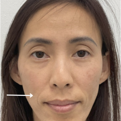Facial Fillers Before & After Patient #4130