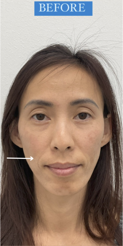Facial Fillers Before & After Patient #4130