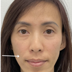 Facial Fillers Before & After Patient #4130