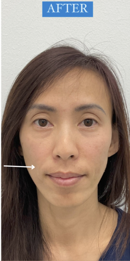 Facial Fillers Before & After Patient #4130