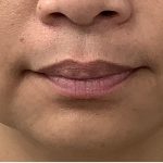 Lip Fillers Before & After Patient #4144