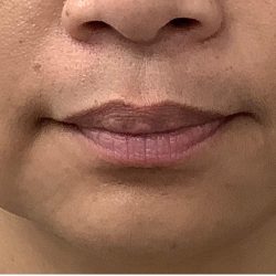 Lip Fillers Before & After Patient #4144
