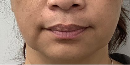 Lip Fillers Before & After Patient #4144