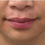 Lip Fillers Before & After Patient #4144