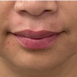 Lip Fillers Before & After Patient #4144