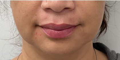 Lip Fillers Before & After Patient #4144