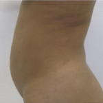 Liposuction Before & After Patient #4123