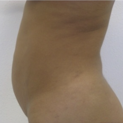 Liposuction Before & After Patient #4123