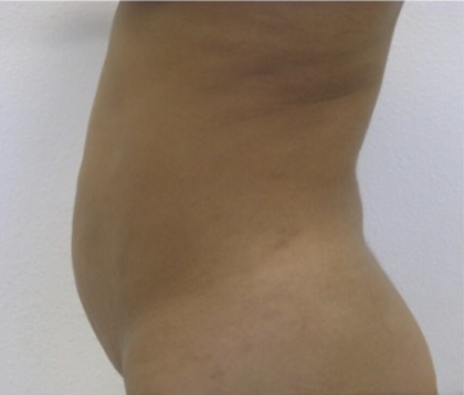 Liposuction Before & After Patient #4123
