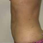 Liposuction Before & After Patient #4123