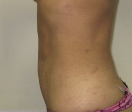 Liposuction Before & After Patient #4123