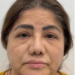 Lower Blepharoplasty Before & After Patient #4131