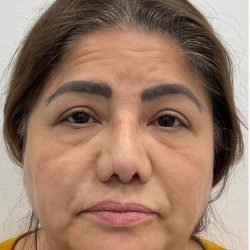 Lower Blepharoplasty Before & After Patient #4131