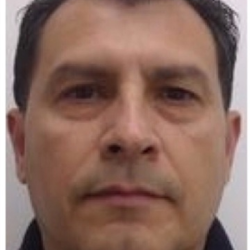 Lower Blepharoplasty Before & After Patient #4156