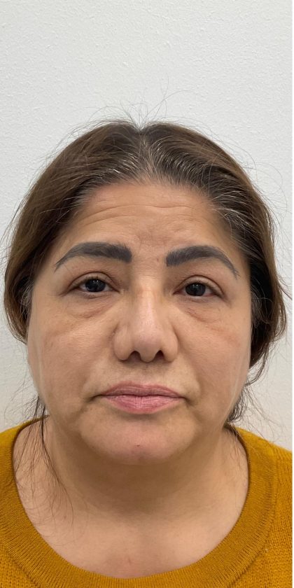 Lower Blepharoplasty Before & After Patient #4131