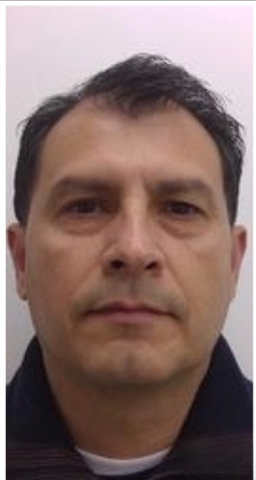 Lower Blepharoplasty Before & After Patient #4156