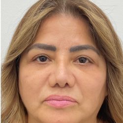 Lower Blepharoplasty Before & After Patient #4131