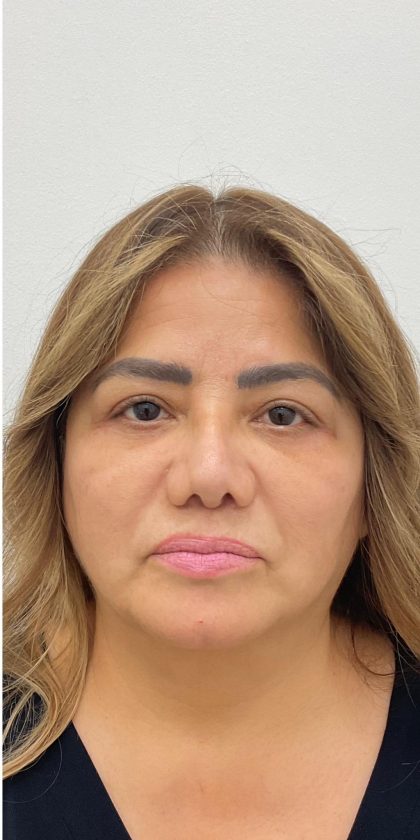 Lower Blepharoplasty Before & After Patient #4131