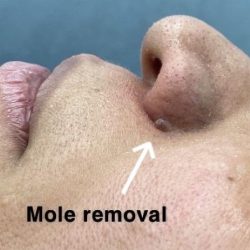 Mole Removal Before & After Patient #4121