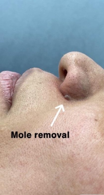 Mole Removal Before & After Patient #4121